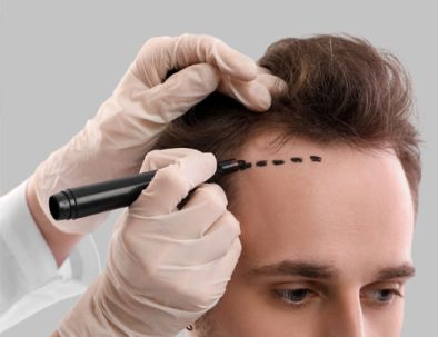 Men hair transplant in Iran